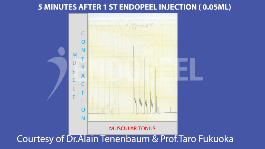 5 minutes after 1 st endopeel injection of 0.05 ml